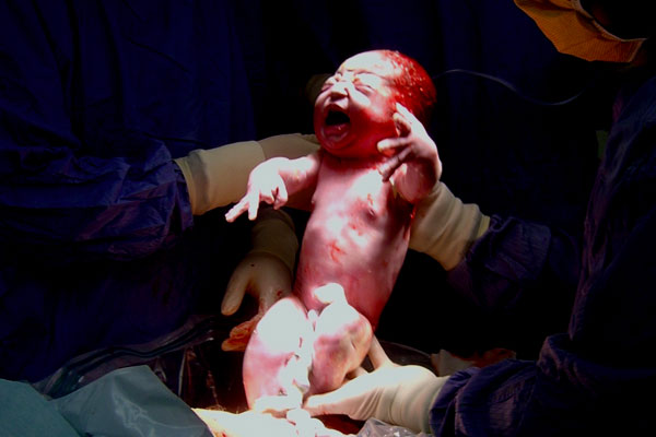 Guide to Preparing for a C-Section